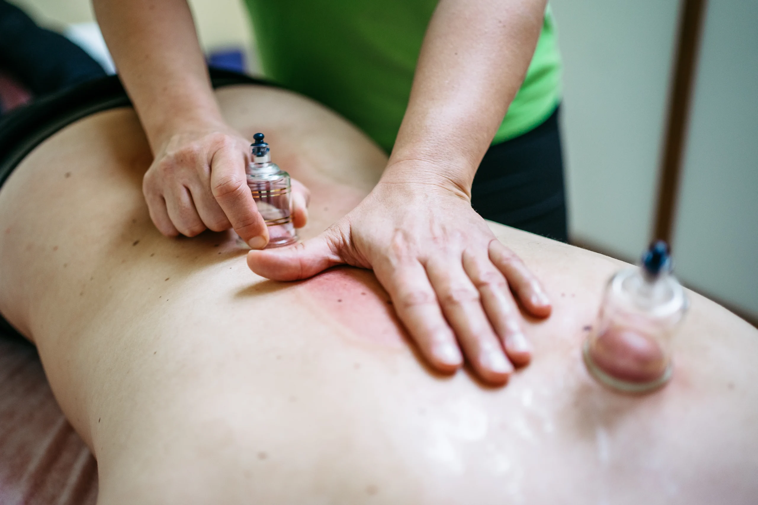 Praxis für Physiotherapie Maria Friebus - Therapie - Schröpfen